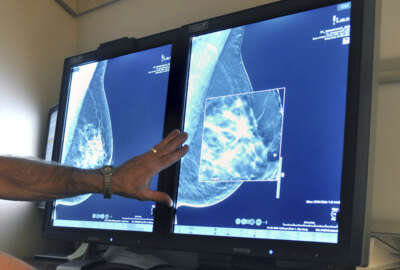 Mammography